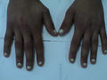 NAIL DISEASES - Leukonychia