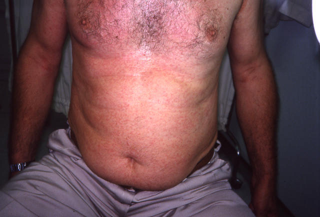 DRUG ERUPTIONS - Drug eruption DRUG ERUPTIONS - Drug eruption