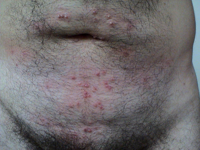 VIRAL INFECTIONS - Mollescum contagiosum VIRAL INFECTIONS - Mollescum contagiosum