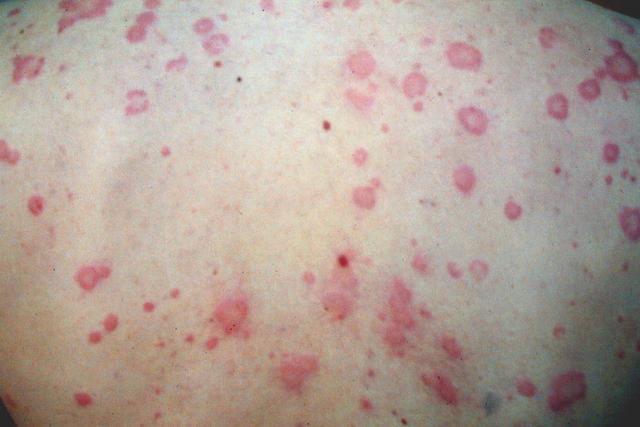 URTICARIA - Urticaria