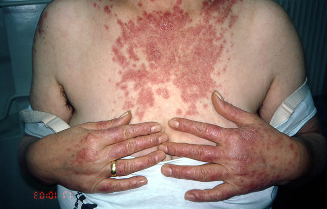 CONNECTIVE TISSUE DISORDERS - Discoid lupus erythematosus