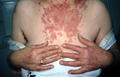 CONNECTIVE TISSUE DISORDERS - Discoid lupus erythematosus