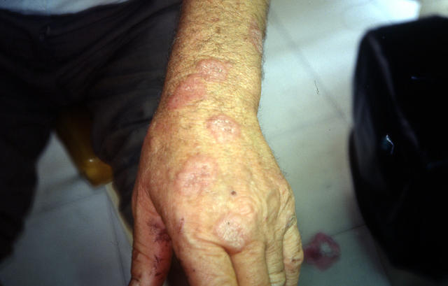 NECROBIOTIC DISORDERS - Granuloma Annulare