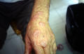 NECROBIOTIC DISORDERS - Granuloma Annulare