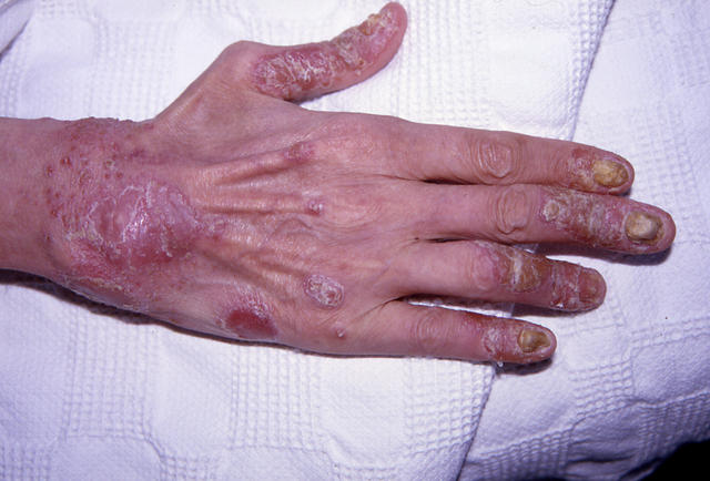 DISEASE OF THE BLOOD AND THE VESSELS – PURPURAS - Reiter disease