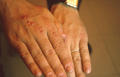 BACTERIAL INFECTIONS - Swimming pool granuloma/ Granulomas due to M. marinum infection