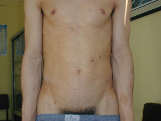 GENODERMATOSES - Neurofibromatosis (νon Recklinghausen's disease) GENODERMATOSES - Neurofibromatosis (νon Recklinghausen's disease)