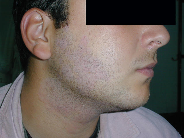 PIGMENTATION DISORDERS - Postinflammatory hypopigmentation