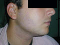 PIGMENTATION DISORDERS - Postinflammatory hypopigmentation