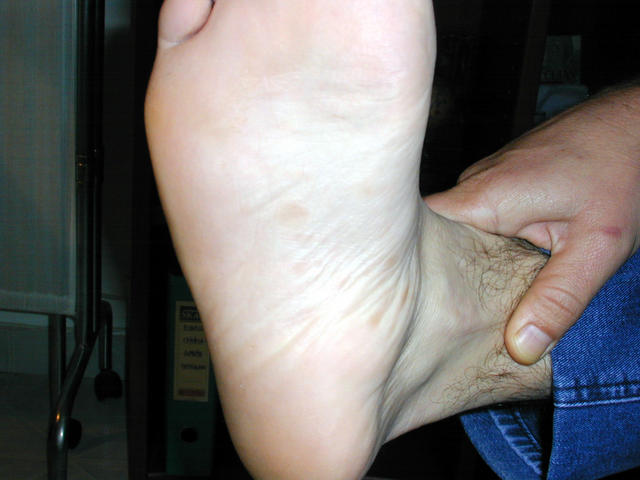 SYPHILIS AND OTHER SEXUAL TRANSMITTED DISEASES - Plantar macular exanthem, secondary syphilis SYPHILIS AND OTHER SEXUAL TRANSMITTED DISEASES - Plantar macular exanthem, secondary syphilis