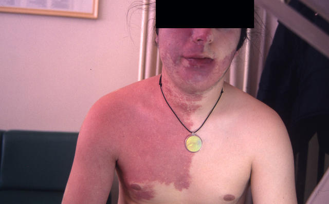 DISEASE OF THE BLOOD AND THE VESSELS – PURPURAS - Hemangioma