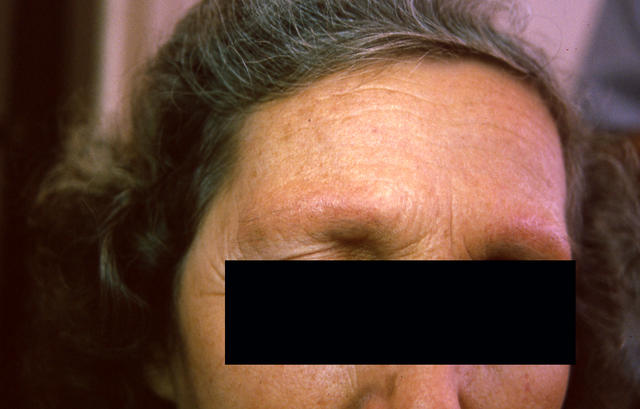 FOLLICULAR SYNDROMES WITH INFLAMMATION AND ATROPHY - Ulerythema ophryogenes