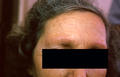 FOLLICULAR SYNDROMES WITH INFLAMMATION AND ATROPHY - Ulerythema ophryogenes