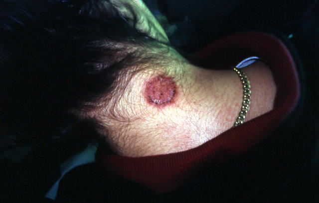 SUPERFICIAL FUNGAL INFECTIONS - Tinea infection