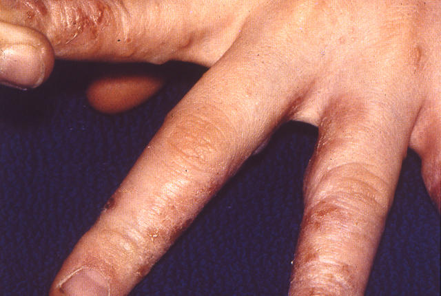 DERMATITIS - EKZEMA - Dyshidrotic eczema DERMATITIS - EKZEMA - Dyshidrotic eczema