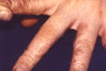 DERMATITIS - EKZEMA - Dyshidrotic eczema
