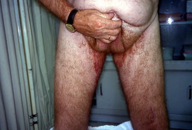 SUPERFICIAL FUNGAL INFECTIONS - Tinea Cruris SUPERFICIAL FUNGAL INFECTIONS - Tinea Cruris