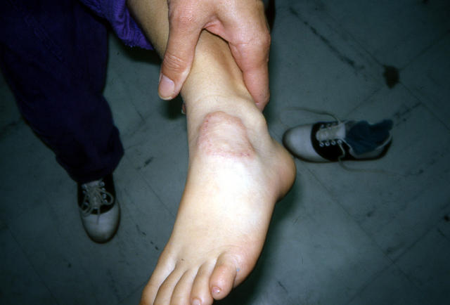 NECROBIOTIC DISORDERS - Granuloma Annulare NECROBIOTIC DISORDERS - Granuloma Annulare