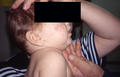 DISEASES OF THE SEBACEOUS GLANDS - Acne infantile
