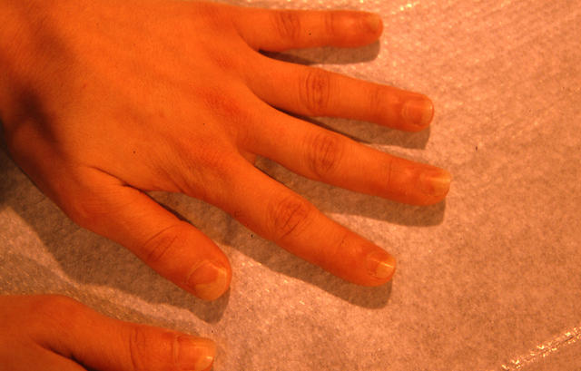 PSORIASIS - Psoriatic nails