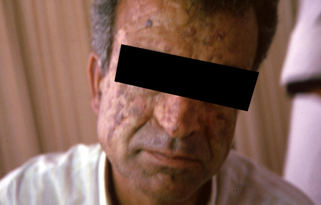 GENODERMATOSES - Xeroderma pigmentosum