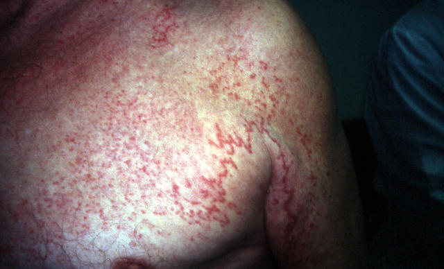 NECROBIOTIC DISORDERS - Granuloma Annulare, Generalised