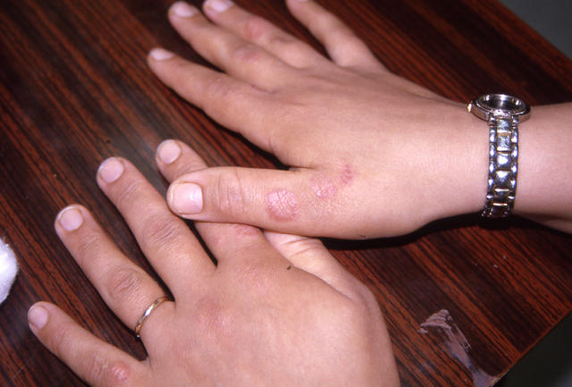 NECROBIOTIC DISORDERS - Granuloma Annulare