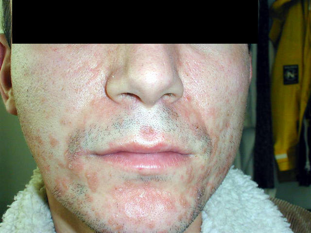 DERMATITIS - EKZEMA - Seborrheic Dermatitis