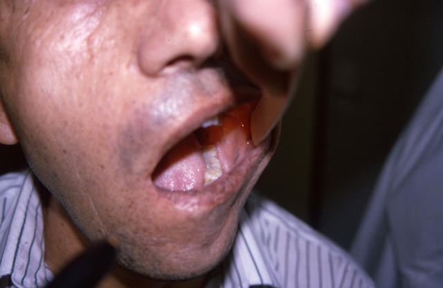 PIGMENTATION DISORDERS - Peutz - Jeghers syndrome PIGMENTATION DISORDERS - Peutz - Jeghers syndrome