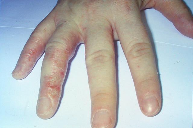 DERMATITIS - EKZEMA - Dyshidrotic eczema