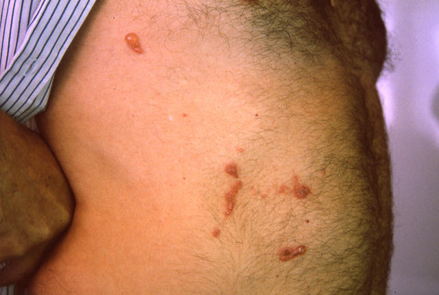 PARASITOSES, BITES - Insect bites PARASITOSES, BITES - Insect bites