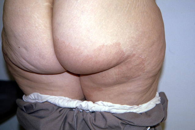 SUPERFICIAL FUNGAL INFECTIONS - Tinea infection SUPERFICIAL FUNGAL INFECTIONS - Tinea infection