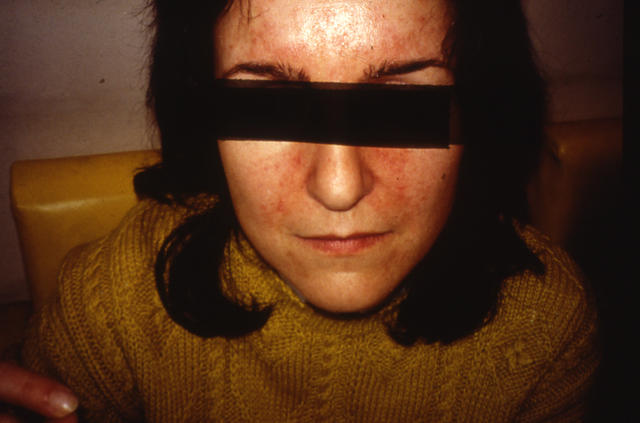 DERMATITIS - EKZEMA - Seborrheic Dermatitis