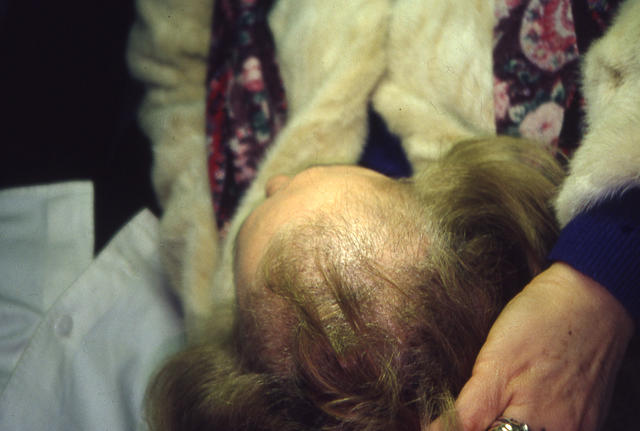 HAIR DISEASES - Trichotillomania HAIR DISEASES - Trichotillomania