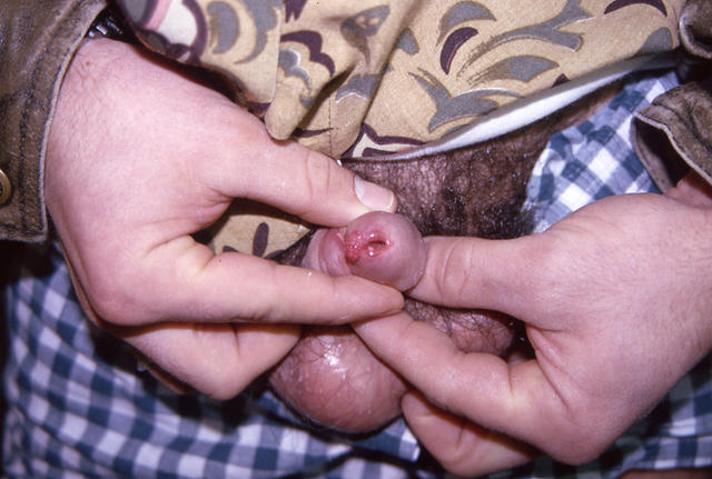 VIRAL INFECTIONS - Condylomata acuminata