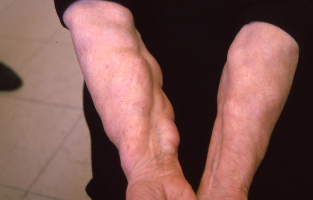 VARIOUS or of UNKNOWN ETIOLOGY DISEASES - Multiple lipomas syndrome