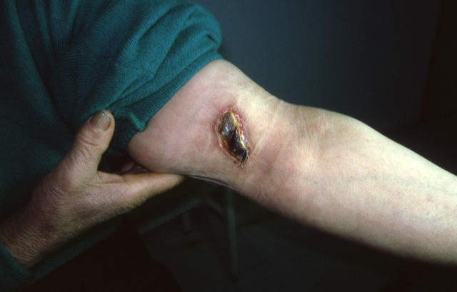 DISEASE OF THE BLOOD AND THE VESSELS – PURPURAS - Pyoderma Gangrenosum