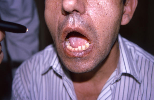 PIGMENTATION DISORDERS - Peutz - Jeghers syndrome