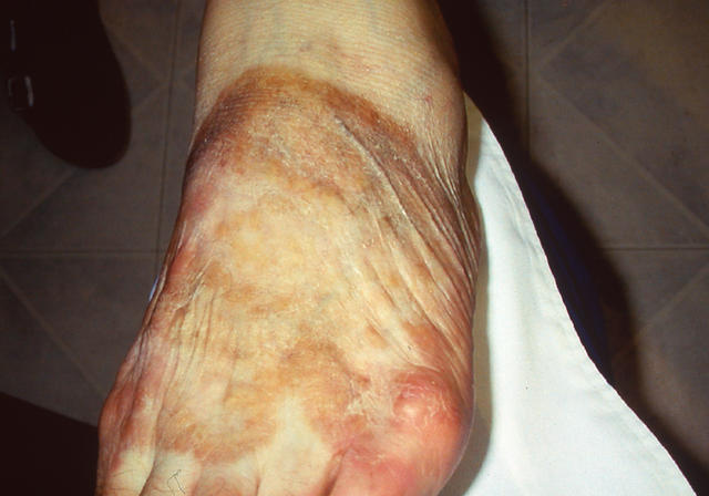 NECROBIOTIC DISORDERS - Granuloma Annulare