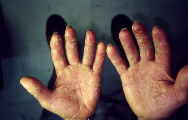DERMATITIS - EKZEMA - Hand eczema DERMATITIS - EKZEMA - Hand eczema
