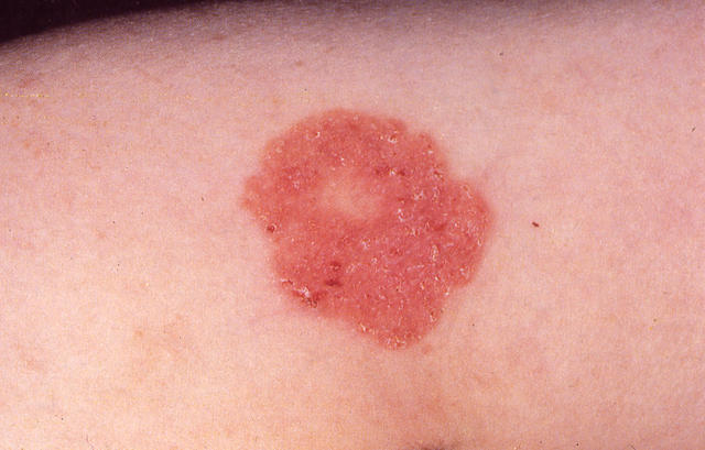 PREMALIGNANT LESIONS - Bowen disease