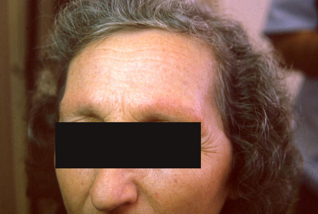 FOLLICULAR SYNDROMES WITH INFLAMMATION AND ATROPHY - Ulerythema ophryogenes FOLLICULAR SYNDROMES WITH INFLAMMATION AND ATROPHY - Ulerythema ophryogenes
