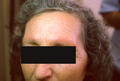 FOLLICULAR SYNDROMES WITH INFLAMMATION AND ATROPHY - Ulerythema ophryogenes