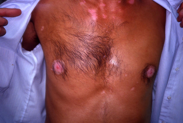 PIGMENTATION DISORDERS - Vitiligo PIGMENTATION DISORDERS - Vitiligo