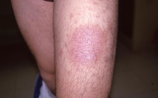 SUPERFICIAL FUNGAL INFECTIONS - Tinea infection SUPERFICIAL FUNGAL INFECTIONS - Tinea infection