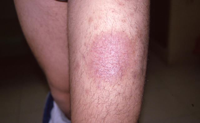 SUPERFICIAL FUNGAL INFECTIONS - Tinea infection