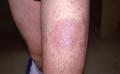 SUPERFICIAL FUNGAL INFECTIONS - Tinea infection