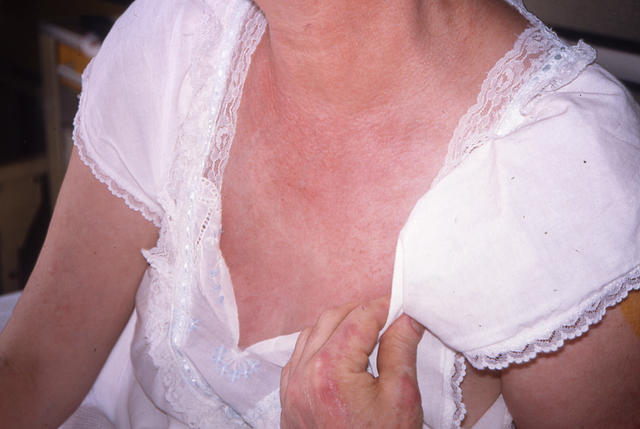 CONNECTIVE TISSUE DISORDERS - Dermatomyositis