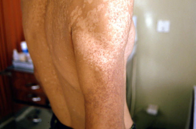 KERATINISATION DISORDERS - Darier disease KERATINISATION DISORDERS - Darier disease