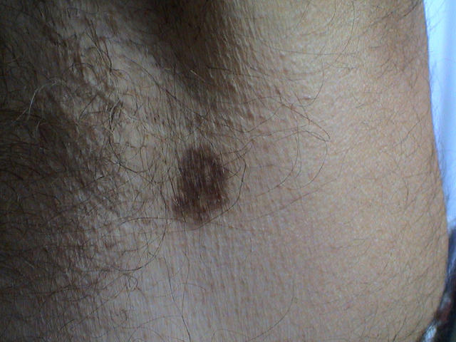 LICHEN - Lichen planus pigmentosus LICHEN - Lichen planus pigmentosus